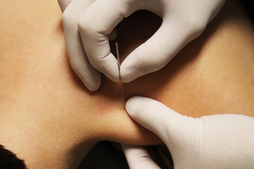 Does Dry Needling Work For Body Pains